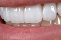 Facetas dentais: tudo o que você precisa saber antes de transformar o seu sorriso